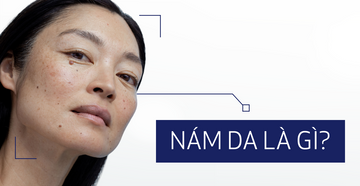 Nám Da Là Gì? Tìm Hiểu Về Nám Da Mặt Để Điều Trị Tốt Hơn