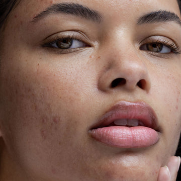 Nổi mụn ở trán: 5 nguyên nhân, cách trị mụn và phòng tránh