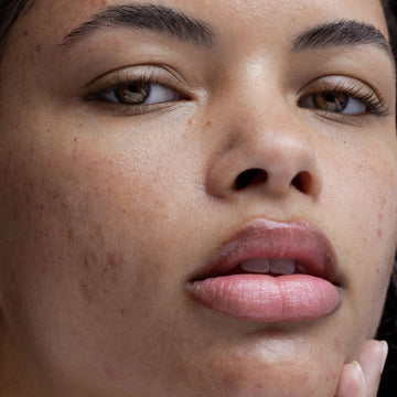 skincare-cho-da-bi-kich-ung