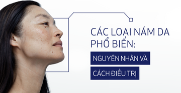Các loại nám da phổ biến: Nguyên nhân, dấu hiệu và cách điều trị