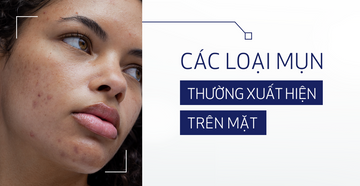 cac-loai-mun-tren-mat