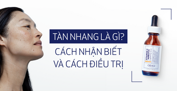 Cách phân biệt nám và tàn nhang đơn giản
