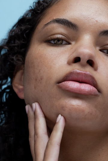 Mụn bọc: Nguyên nhân hình thành và bí quyết điều trị tận gốc