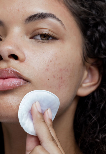 Mụn bọc ở cằm: Nguyên nhân và Cách điều trị hiệu quả