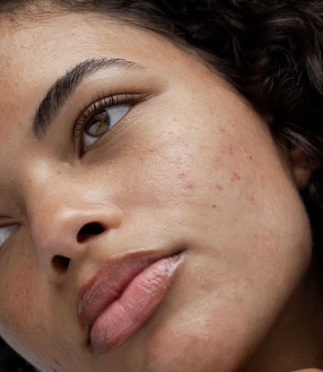 3 cách trị mụn ẩn dưới da tại nhà an toàn và hiệu quả