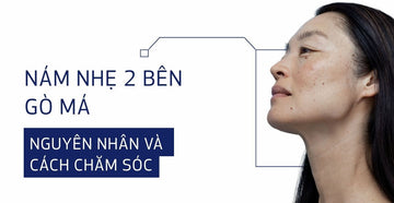 Nám nhẹ 2 bên gò má: Nguyên nhân và cách chăm sóc